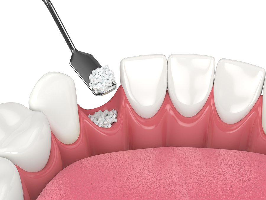 Understanding Bone Grafting in Jacksonville Beach, FL: Restoring Your Dental Foundation