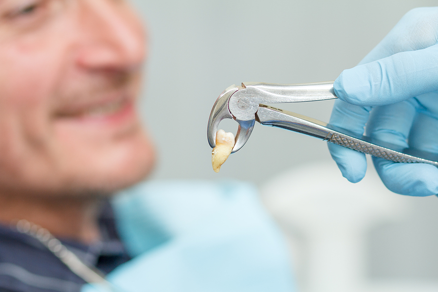 A Comprehensive Guide to Dental Extractions in Jacksonville Beach, FL