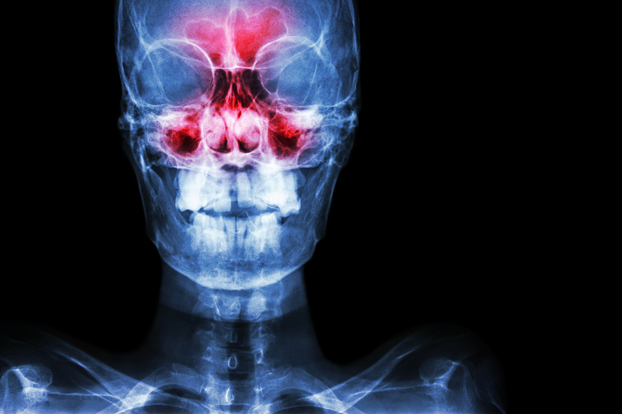 Understanding Sinus Grafting in Jacksonville Beach, FL: A Path to a Healthier Smile